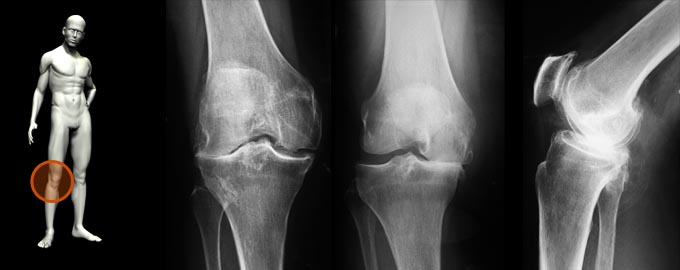 Артроз коленных суставов лечение гомеопатией